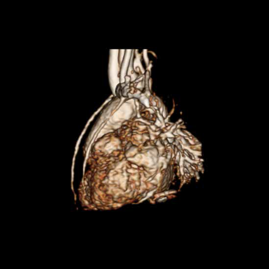 心脏核磁共振成像